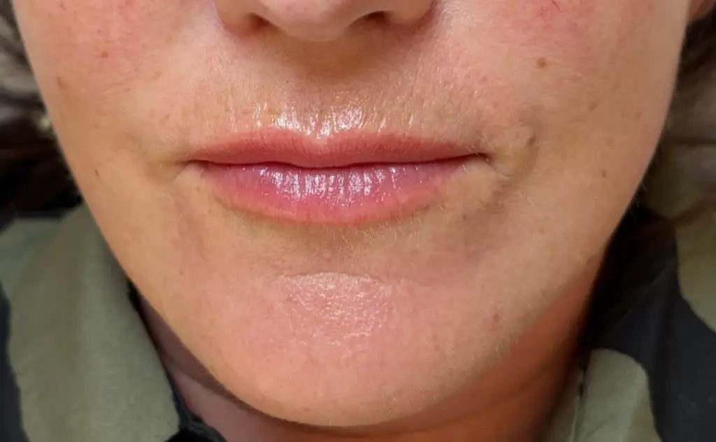 Lip neutralisation before and after by Bea Pereira, Bristol